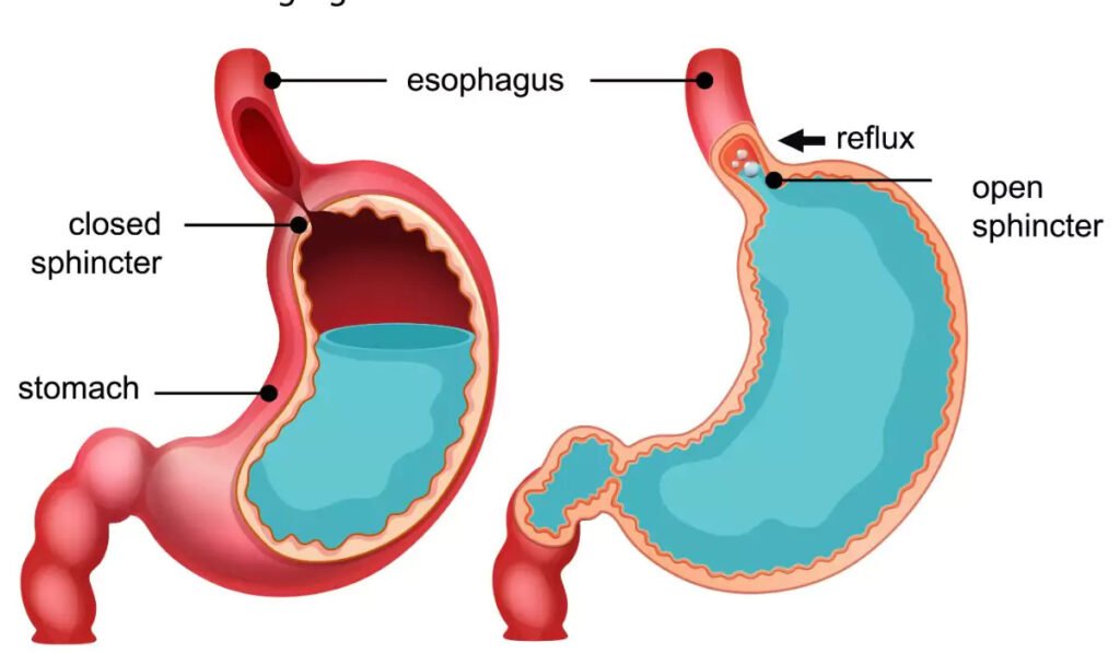 Acid reflux