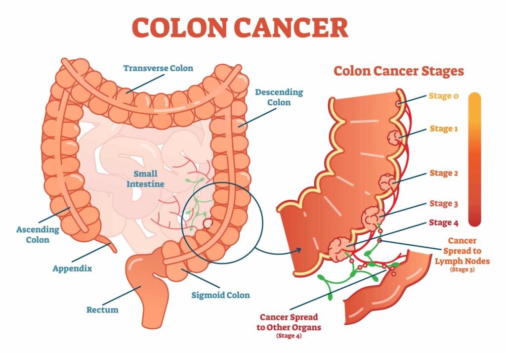 colorectal health