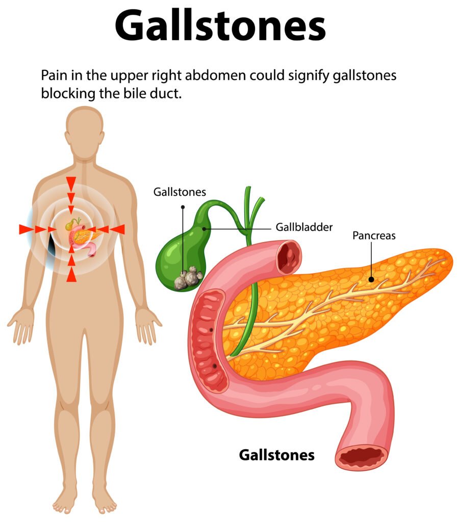 Gallstones