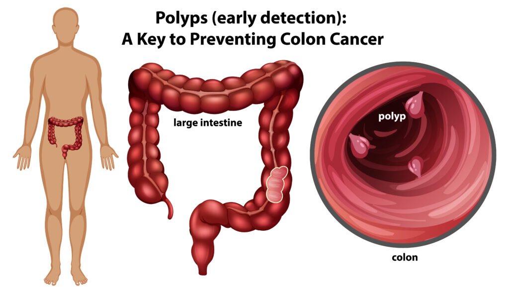 Understanding Colon Polyps and Prevention