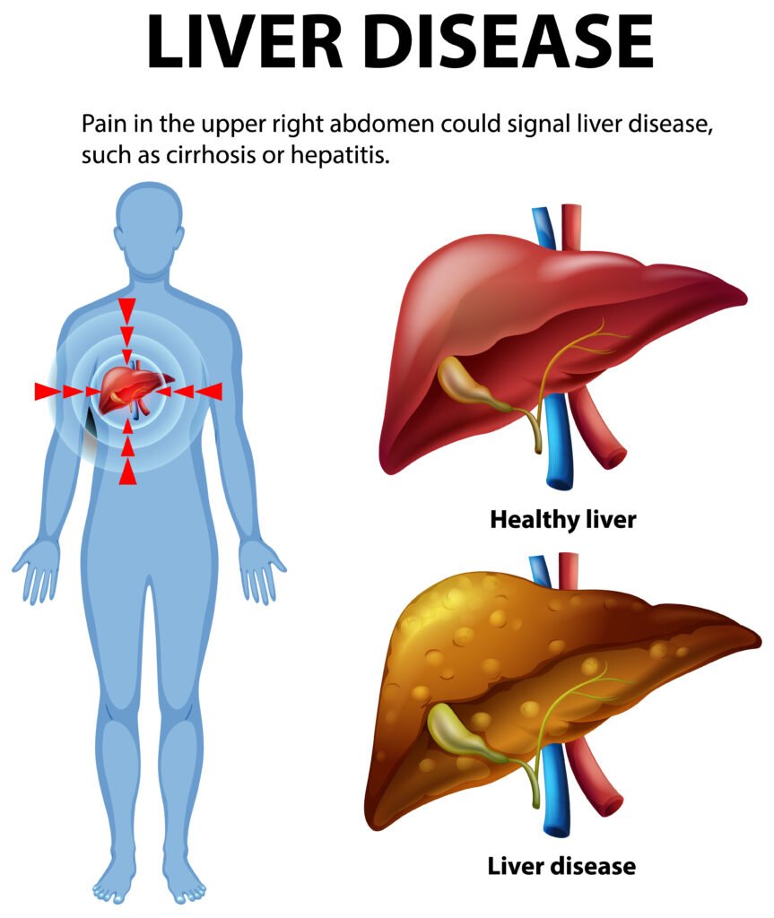 Fatty Liver Disease
