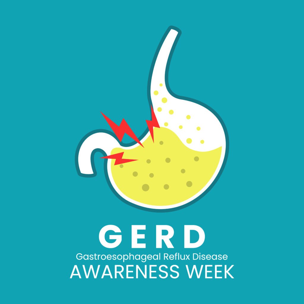 Gastroesophageal Reflux Disease