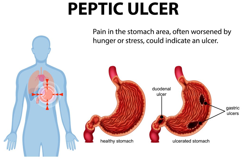 Stomach Ulcers